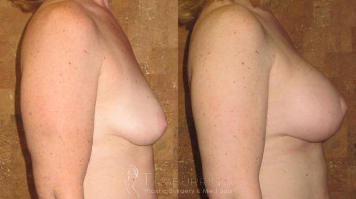 Before & After Breast Augmentation Case 14 Side #1 View in Doylestown, PA