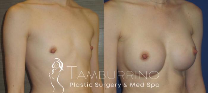 Before & After Breast Augmentation Case 15 Oblique #1 View in Doylestown, PA