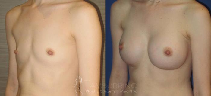 Before & After Breast Augmentation Case 15 Oblique #2 View in Doylestown, PA