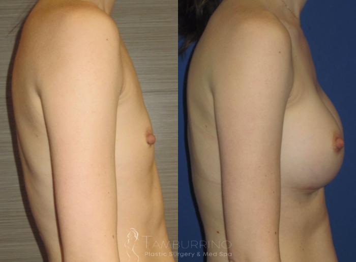 Before & After Breast Augmentation Case 15 Side #1 View in Doylestown, PA