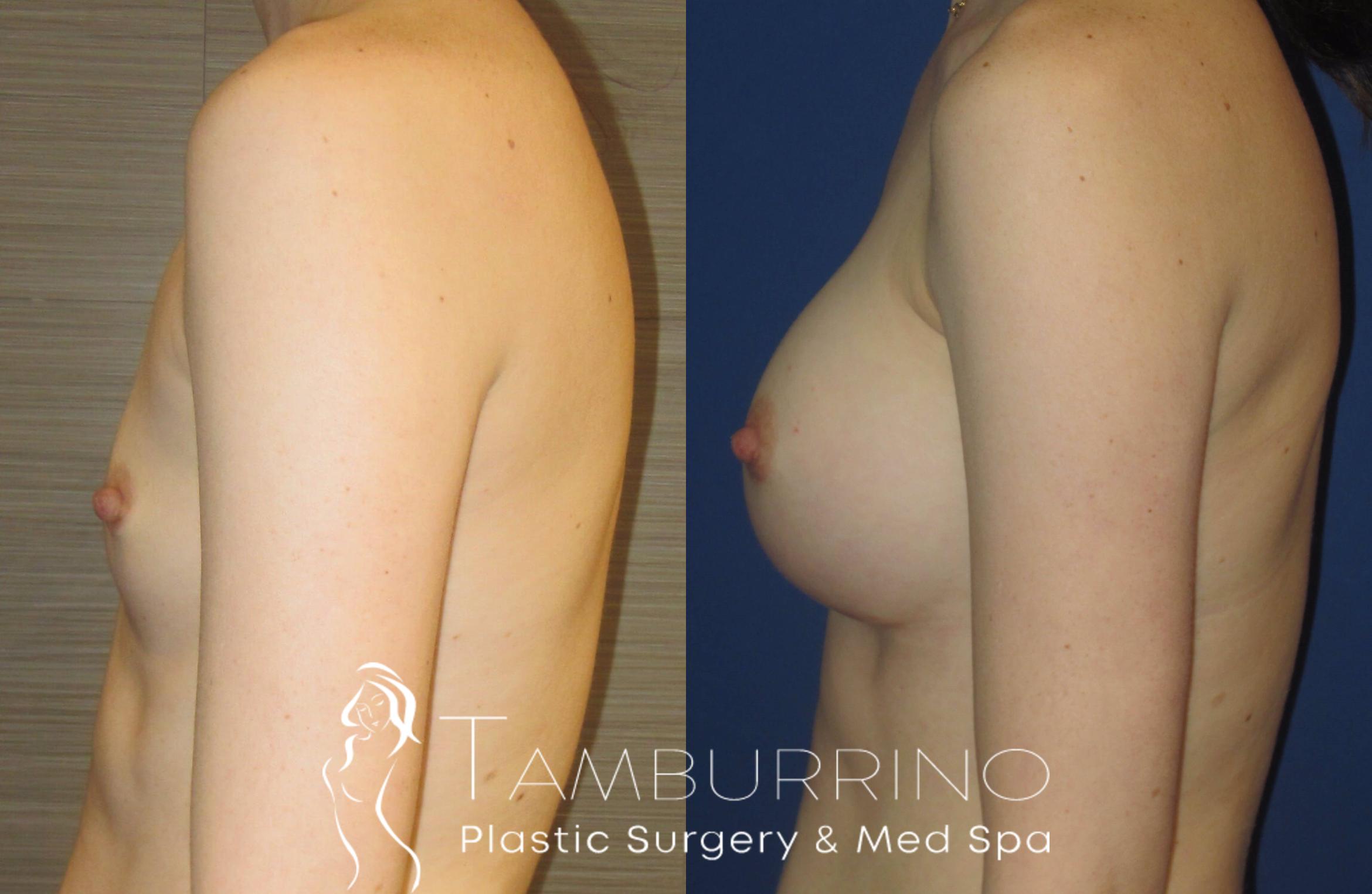 Before & After Breast Augmentation Case 15 Side #2 View in Doylestown, PA