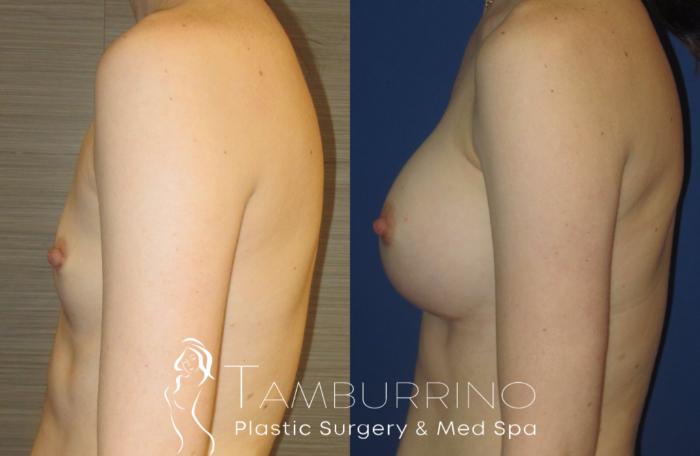 Before & After Breast Augmentation Case 15 Side #2 View in Doylestown, PA