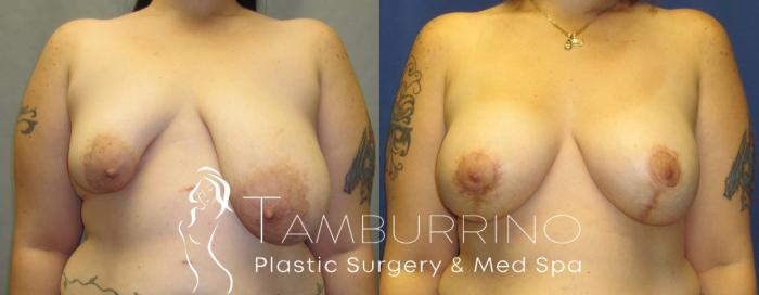 Before & After Breast Augmentation Case 17 Frontal View in Doylestown, PA