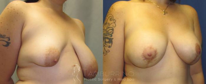 Before & After Breast Augmentation Case 17 Oblique #1 View in Doylestown, PA