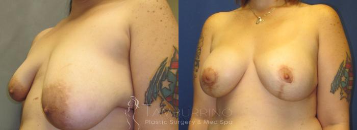 Before & After Breast Augmentation Case 17 Oblique #2 View in Doylestown, PA