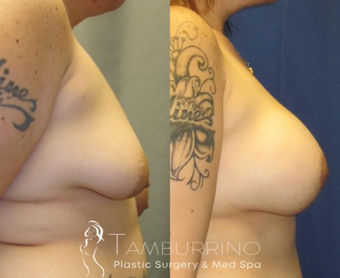 Before & After Breast Augmentation Case 17 Side #1 View in Doylestown, PA