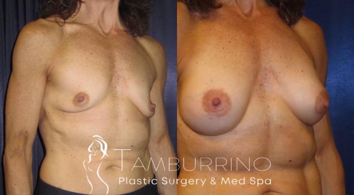 Before & After Breast Augmentation Case 2 Oblique View in Doylestown, PA