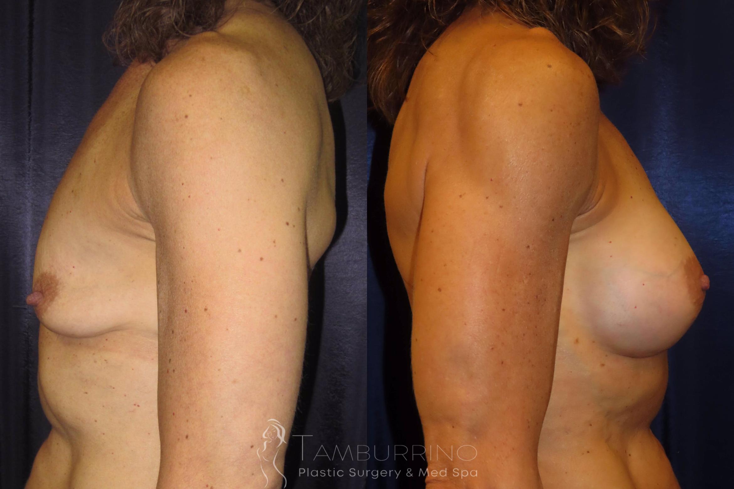 Before & After Breast Augmentation Case 2 Side View in Doylestown, PA