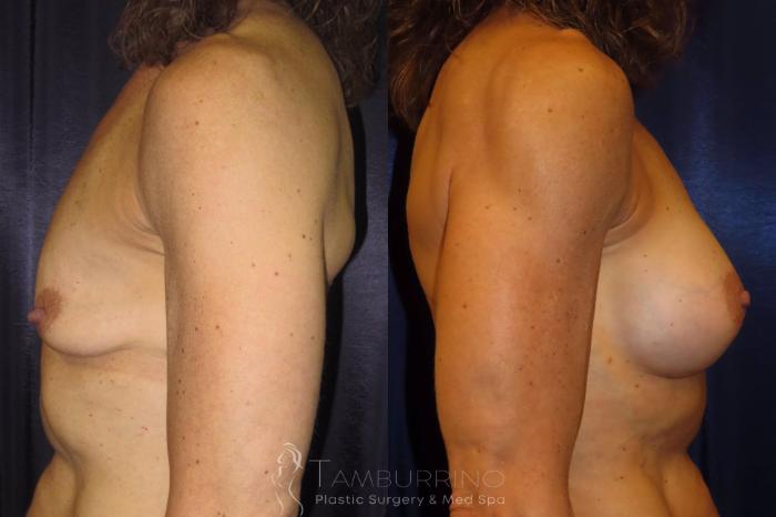 Before & After Breast Augmentation Case 2 Side View in Doylestown, PA