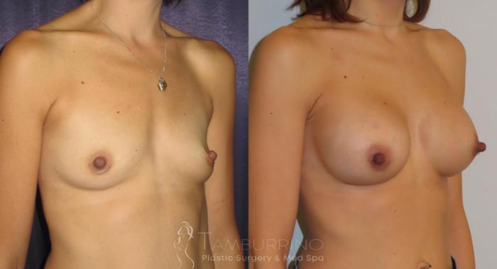 Before & After Breast Augmentation Case 3 Oblique View in Doylestown, PA