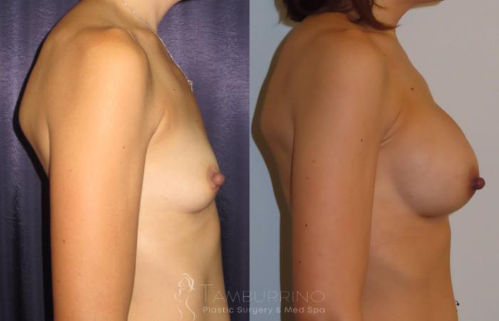 Before & After Breast Augmentation Case 3 Side View in Doylestown, PA