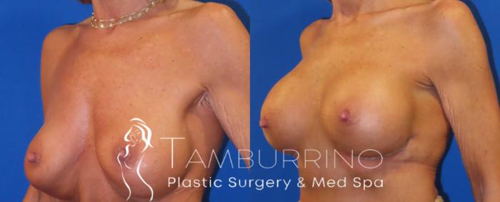 Before & After Breast Augmentation Case 32 Left Oblique View in Doylestown, PA