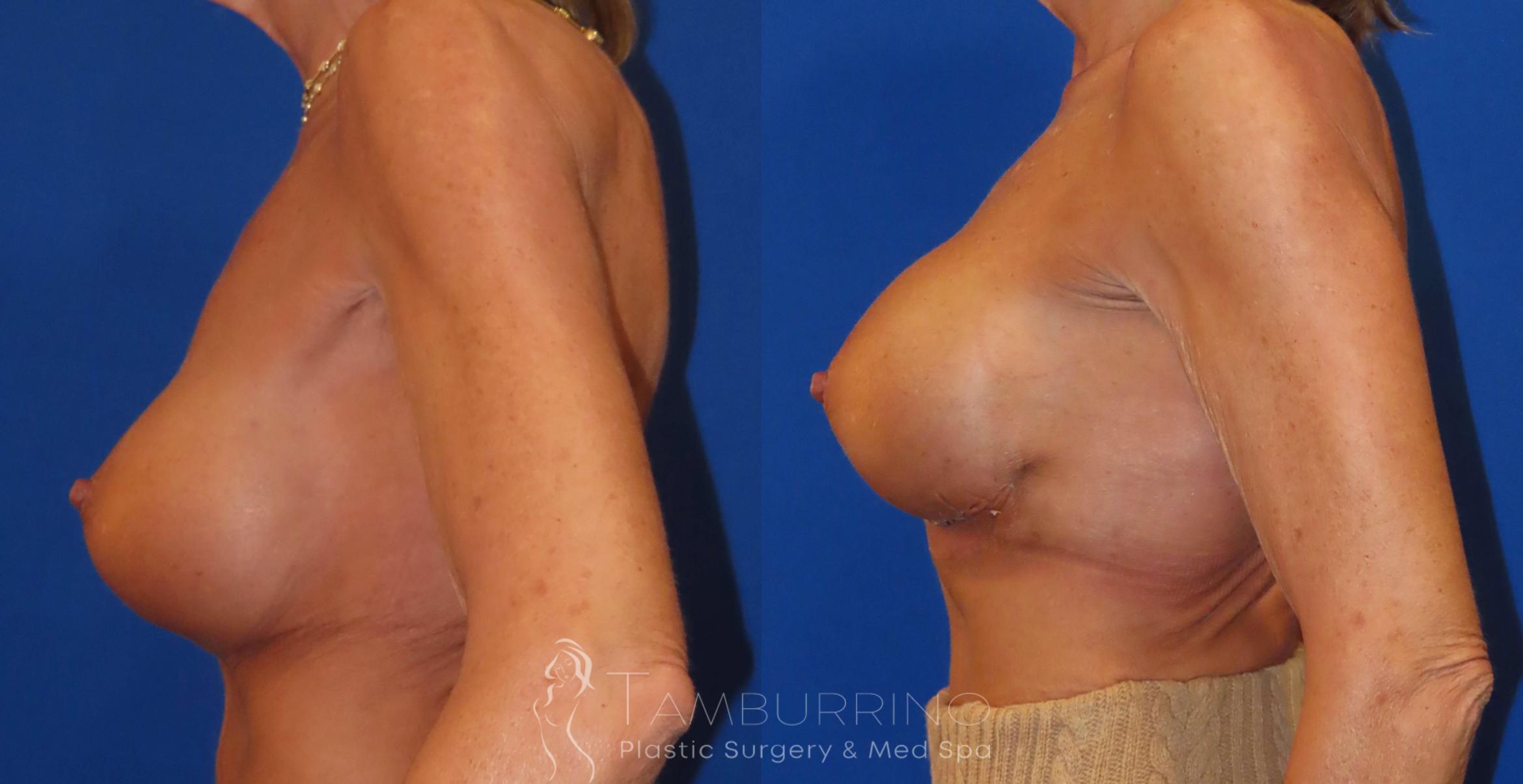 Before & After Breast Augmentation Case 32 Left Side View in Doylestown, PA