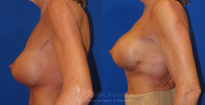 Before & After Breast Augmentation Case 32 Left Side View in Doylestown, PA