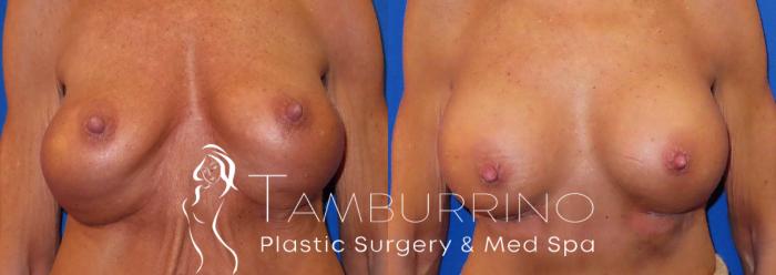Before & After Breast Revision Case 32 Revision Augmentation Front View in Doylestown, PA