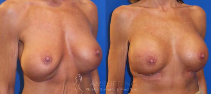 Before & After Breast Augmentation Case 32 Right Oblique View in Doylestown, PA