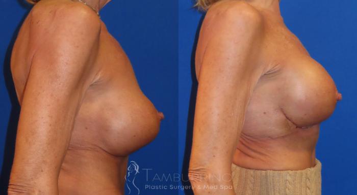 Before & After Breast Augmentation Case 32 Right Side View in Doylestown, PA