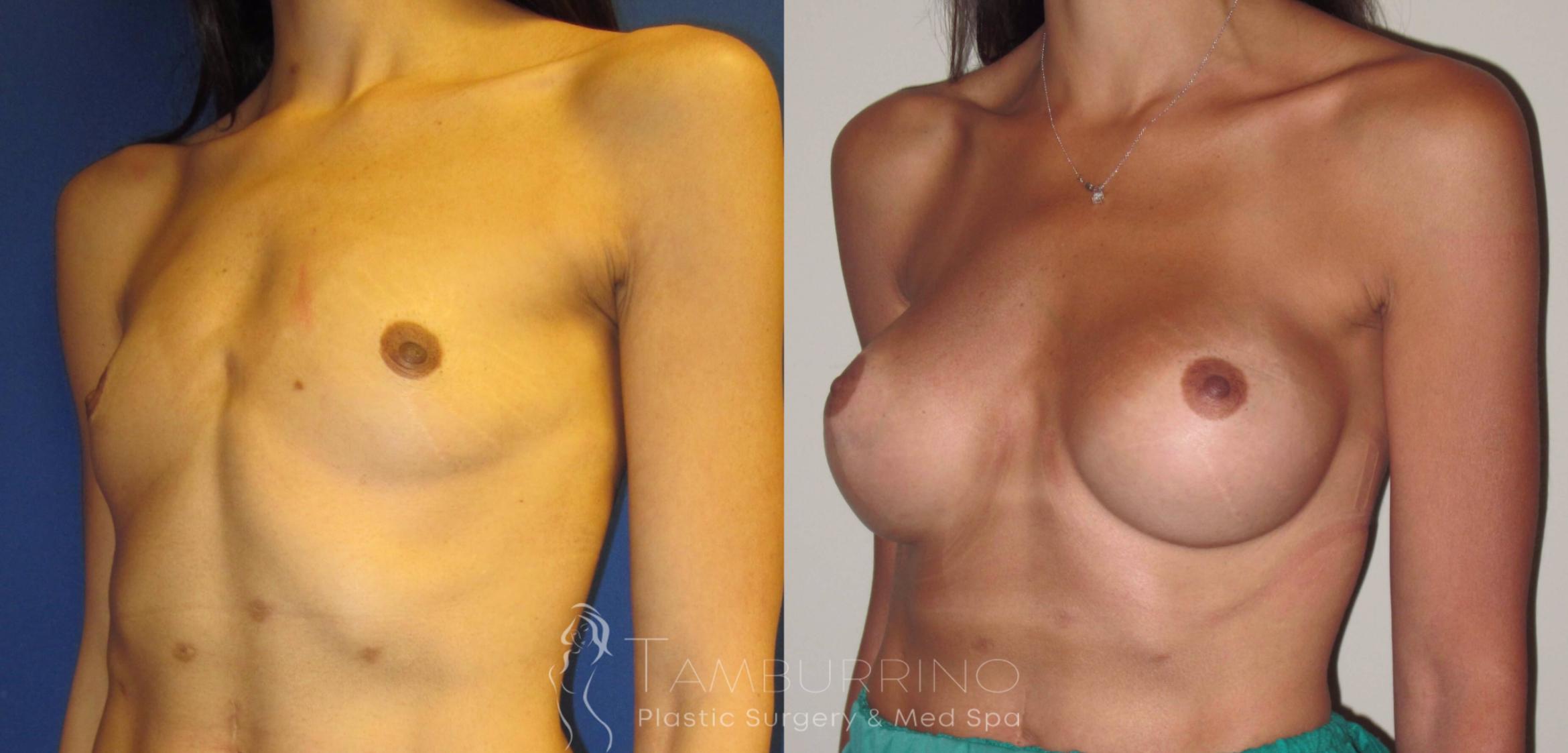 Before & After Breast Augmentation Case 4 Oblique View in Doylestown, PA