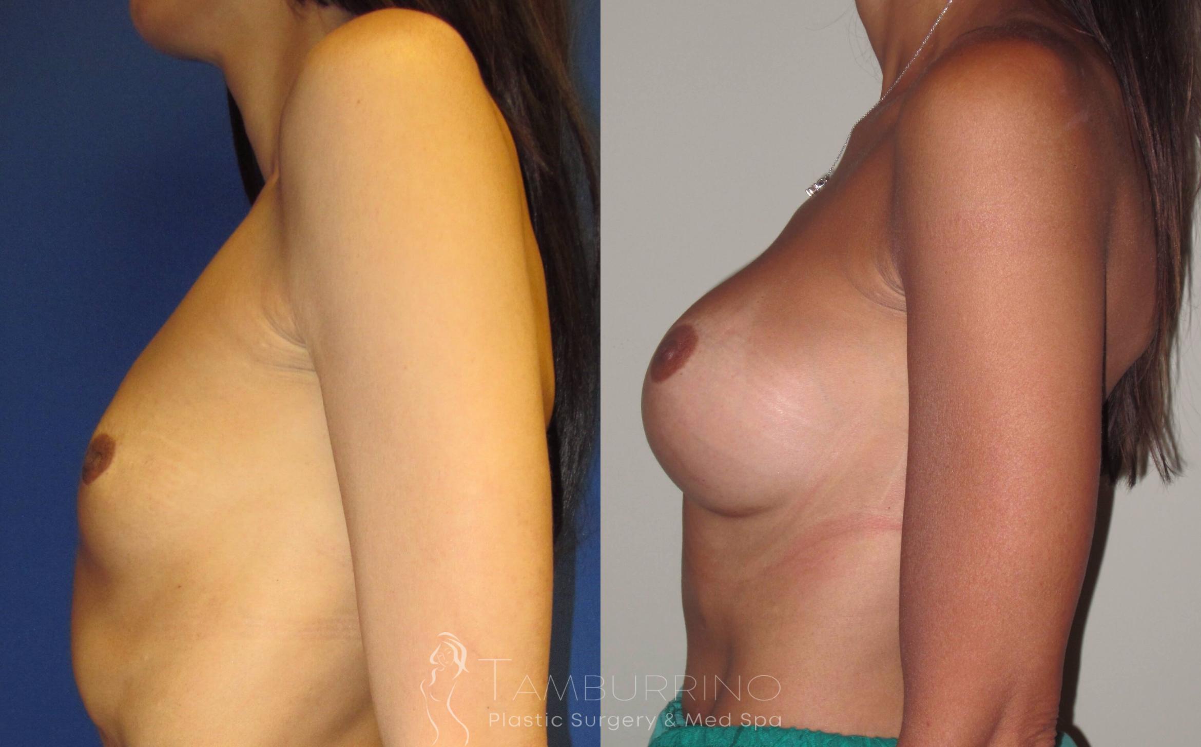 Before & After Breast Augmentation Case 4 Side View in Doylestown, PA