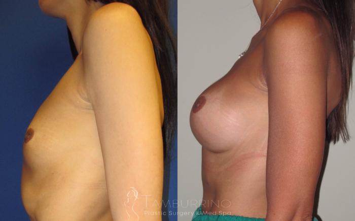 Before & After Breast Augmentation Case 4 Side View in Doylestown, PA