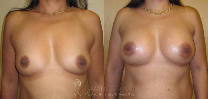 Before & After Breast Augmentation Case 5 Frontal View in Doylestown, PA