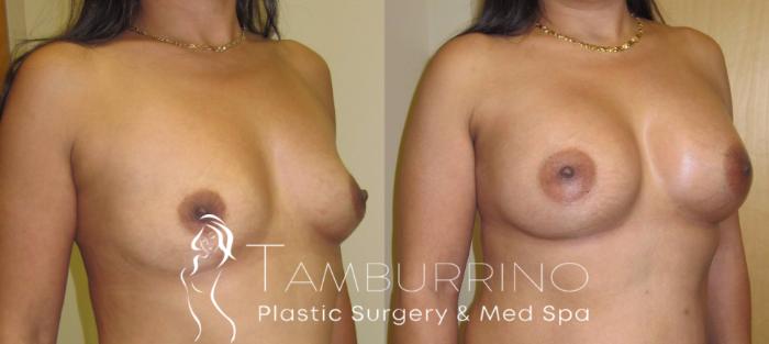 Before & After Breast Augmentation Case 5 Oblique View in Doylestown, PA