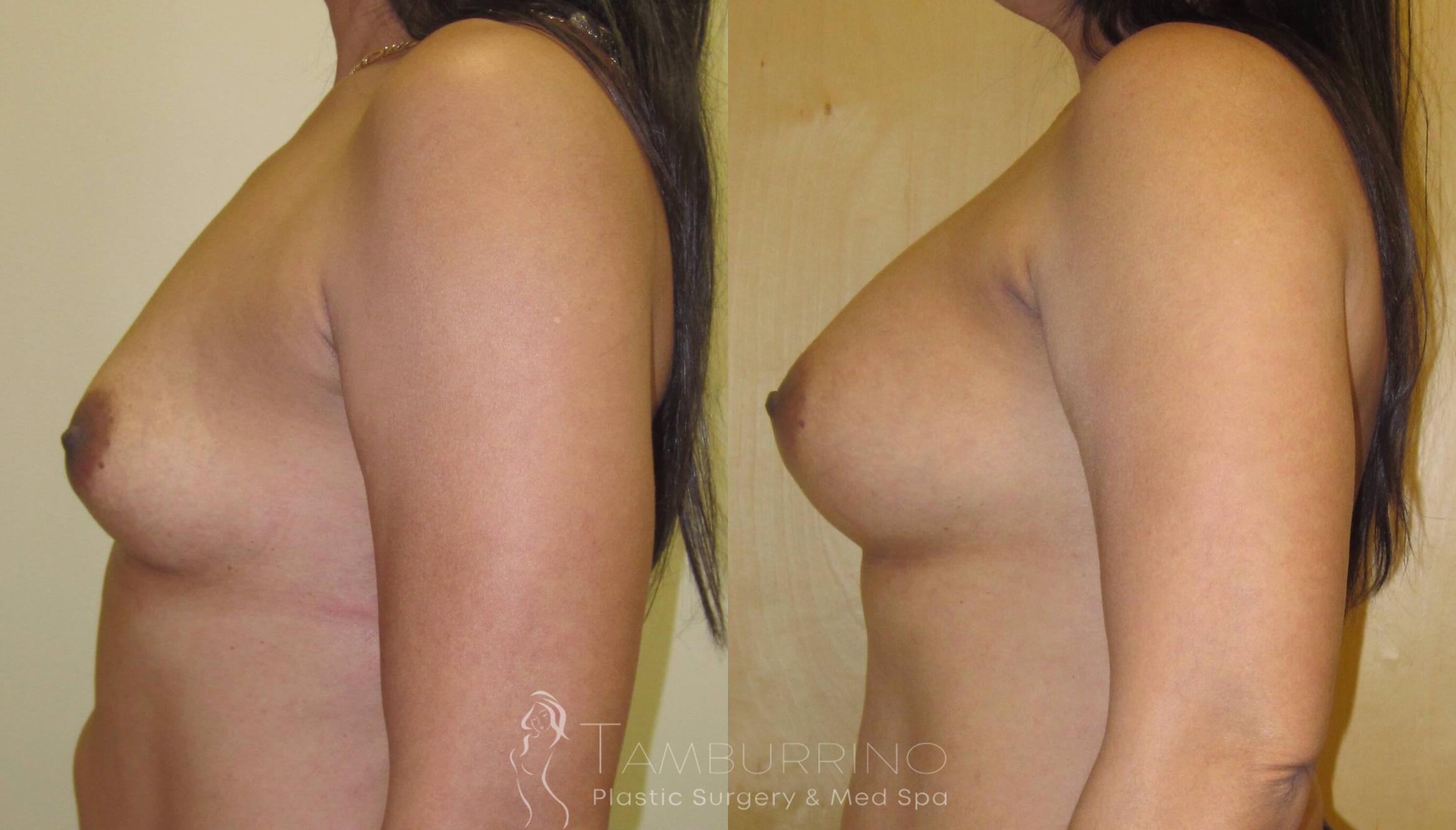 Before & After Breast Augmentation Case 5 Side View in Doylestown, PA