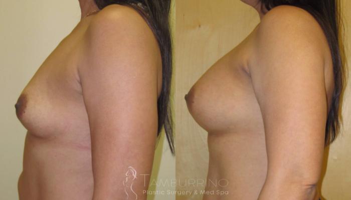 Before & After Breast Augmentation Case 5 Side View in Doylestown, PA