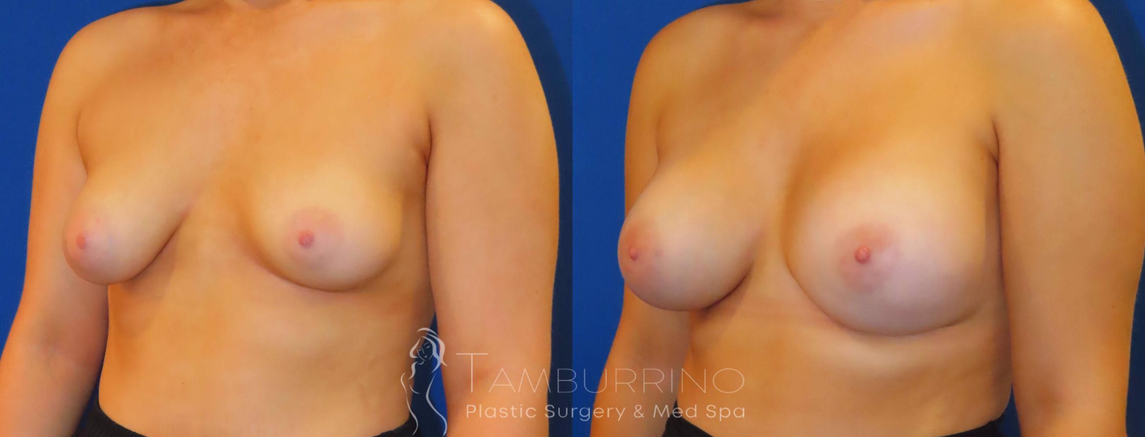 Before & After Breast Augmentation Case 55 Left Oblique View in Doylestown, PA
