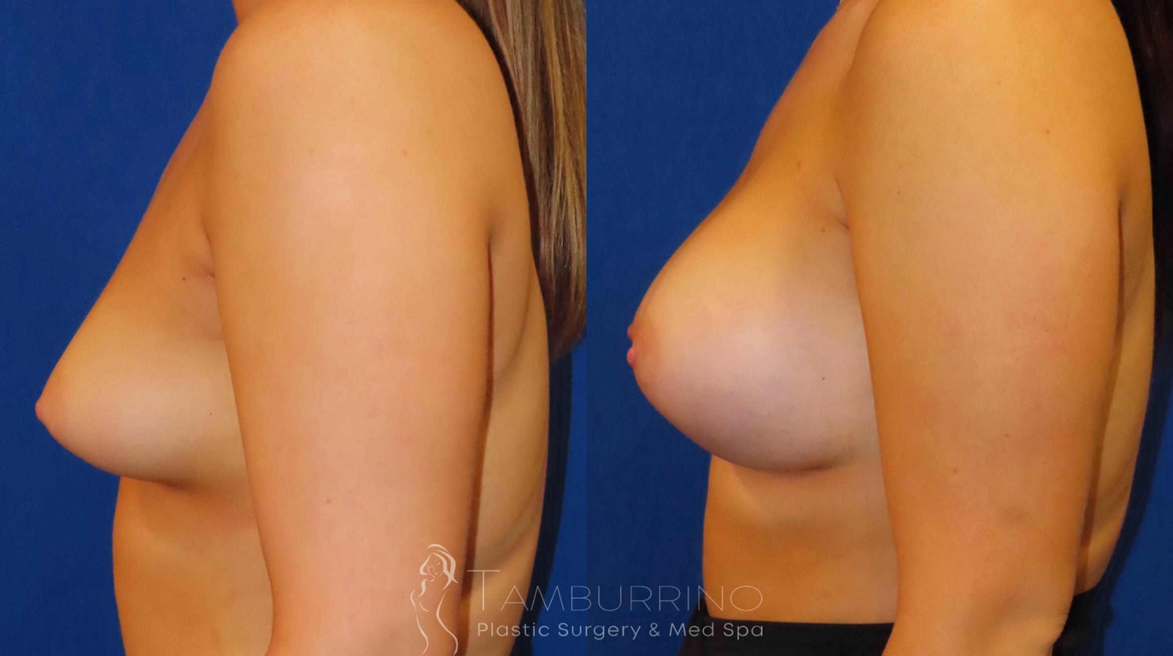 Before & After Breast Augmentation Case 55 Left Side View in Doylestown, PA