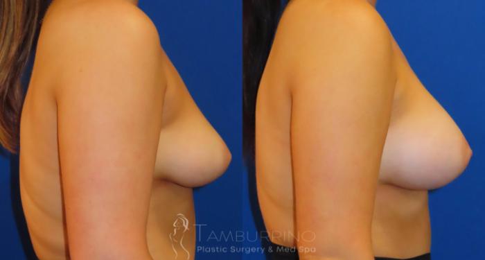 Before & After Breast Augmentation Case 55 Right Side View in Doylestown, PA
