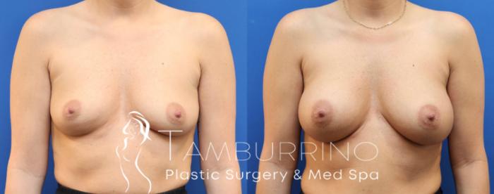Before & After Breast Augmentation Case 77 Front View in Doylestown, PA