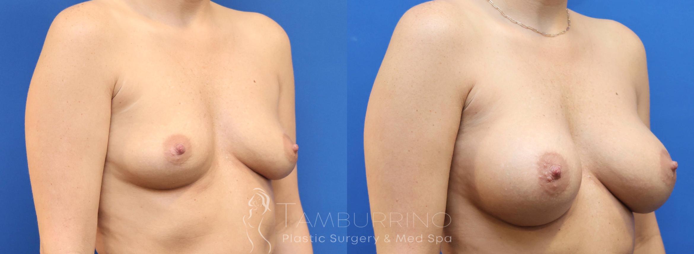 Before & After Breast Augmentation Case 77 Right Oblique View in Doylestown, PA