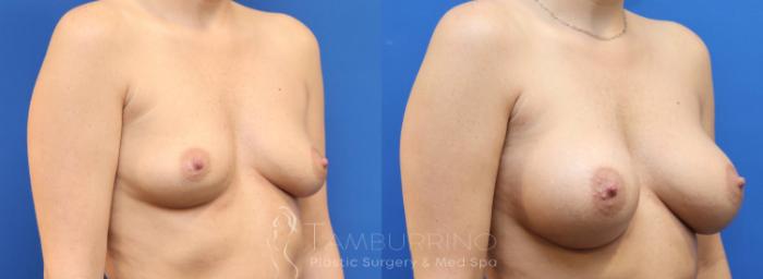 Before & After Breast Augmentation Case 77 Right Oblique View in Doylestown, PA