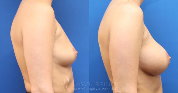 Before & After Breast Augmentation Case 77 Right Side View in Doylestown, PA