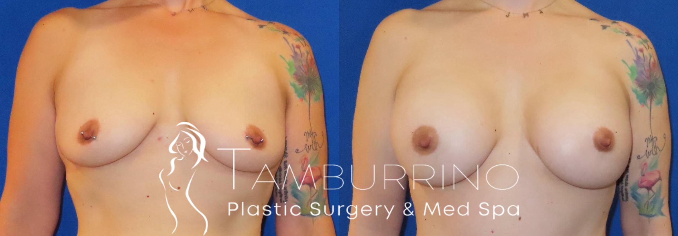 Before & After Breast Augmentation Case 80 Front View in Doylestown, PA