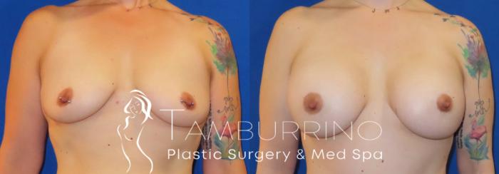 Before & After Breast Augmentation Case 80 Front View in Doylestown, PA