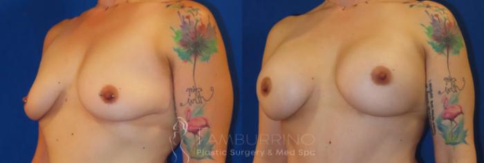 Before & After Breast Augmentation Case 80 Left Oblique View in Doylestown, PA