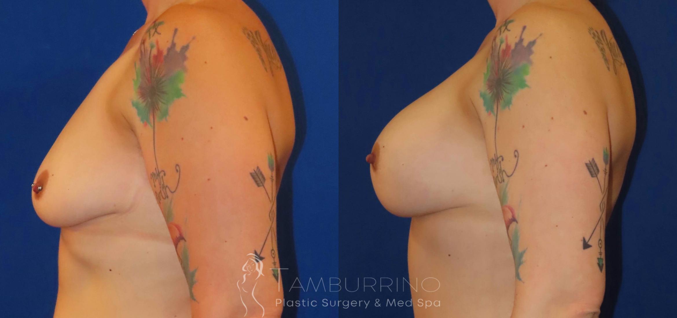 Before & After Breast Augmentation Case 80 Left Side View in Doylestown, PA