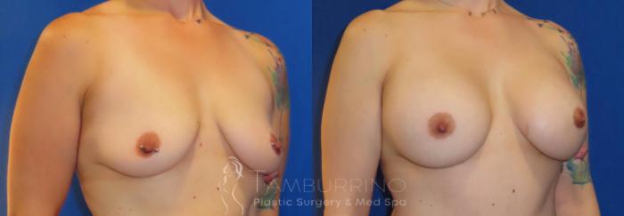 Before & After Breast Augmentation Case 80 Right Oblique View in Doylestown, PA