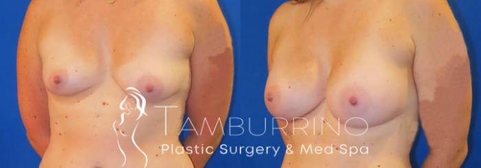 Before & After Breast Augmentation Case 82 Left Oblique View in Doylestown, PA