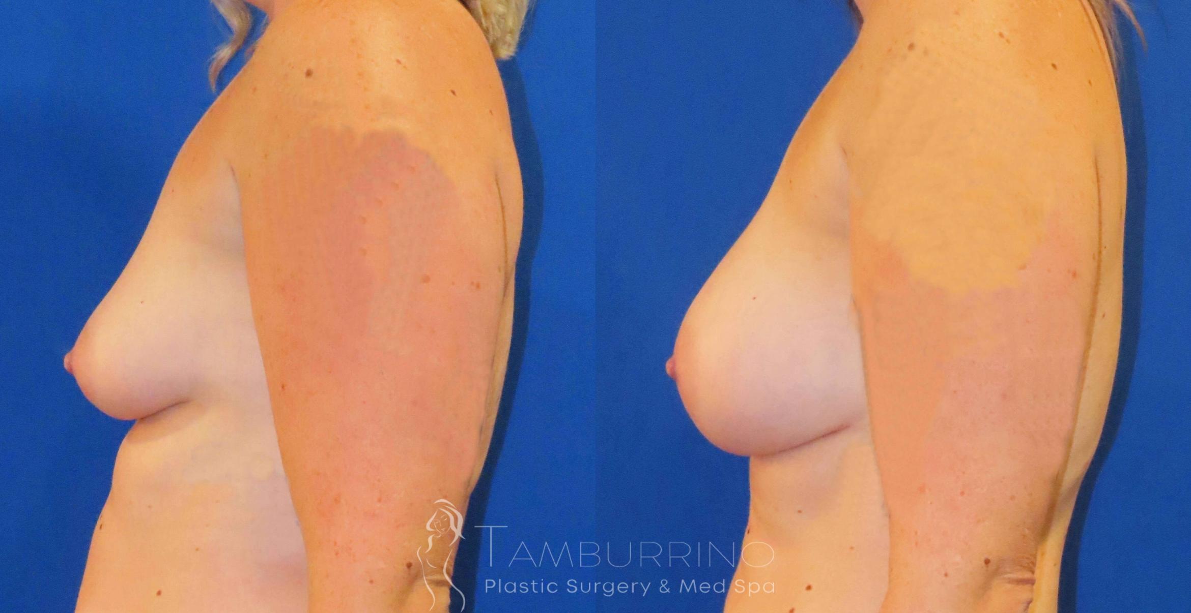 Before & After Breast Augmentation Case 82 Left Side View in Doylestown, PA