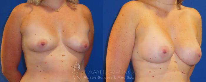 Before & After Breast Augmentation Case 82 Right Oblique View in Doylestown, PA
