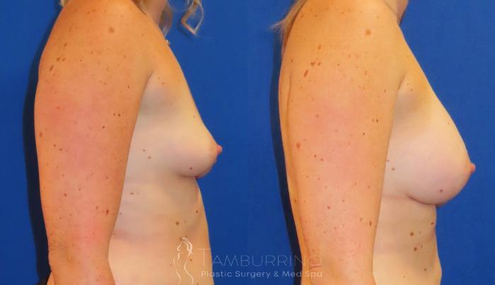 Before & After Breast Augmentation Case 82 Right Side View in Doylestown, PA