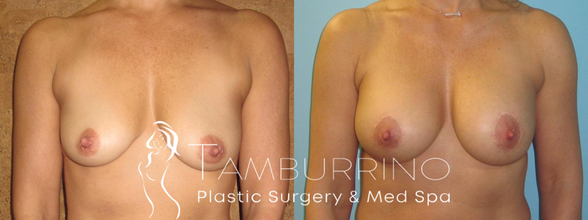 Before & After Breast Augmentation Case 13 Frontal View in Doylestown, PA