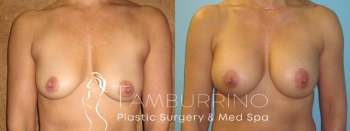 Before & After Breast Augmentation Case 13 Frontal View in Doylestown, PA