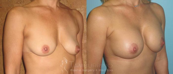 Before & After Breast Augmentation Case 13 Oblique #1 View in Doylestown, PA