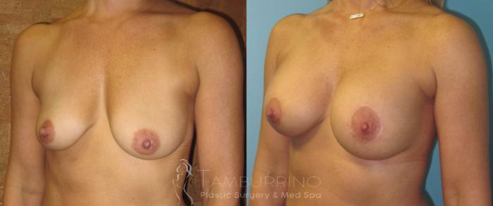 Before & After Breast Augmentation Case 13 Oblique #2 View in Doylestown, PA