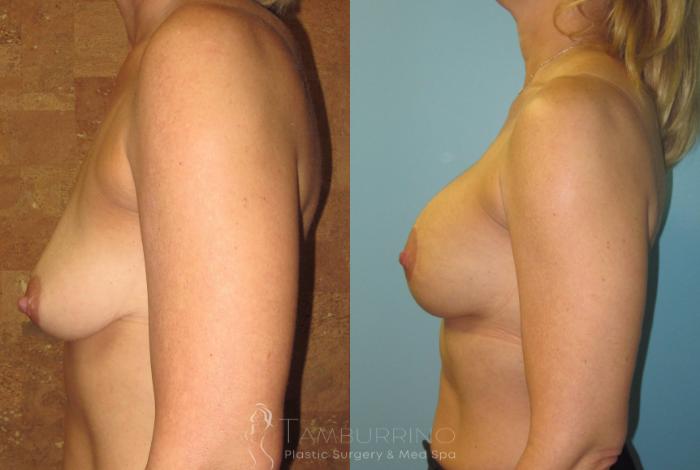 Before & After Breast Augmentation Case 13 Side #2 View in Doylestown, PA