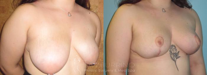 Before & After Breast Lift Case 16 Oblique #1 View in Doylestown, PA